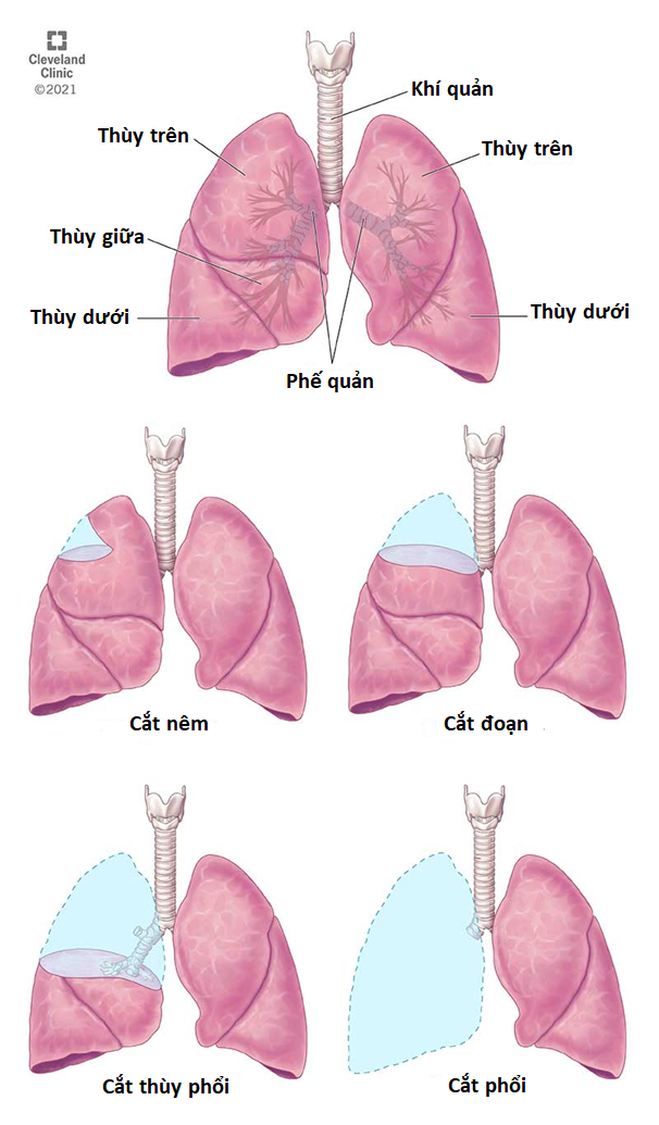 Lung cancer 1 resection(1)